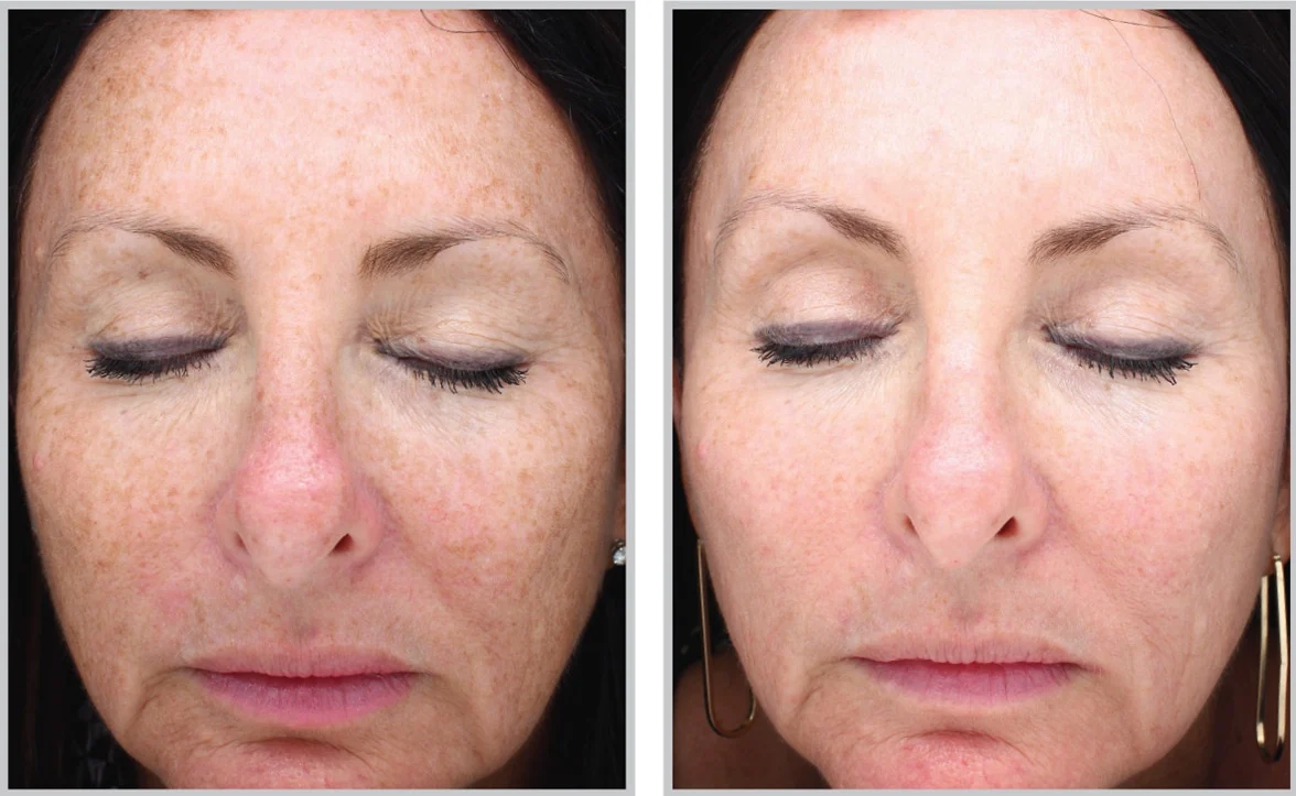 Before and After BBL Treatment