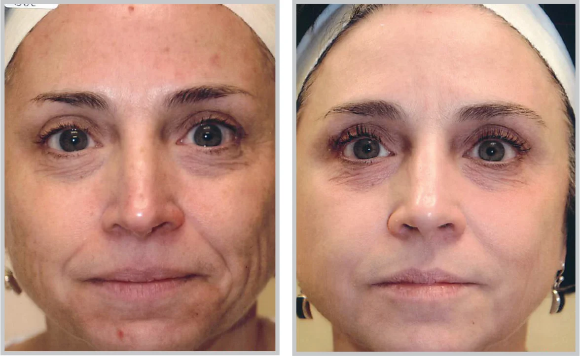 Before and After BBL Treatment - Face
