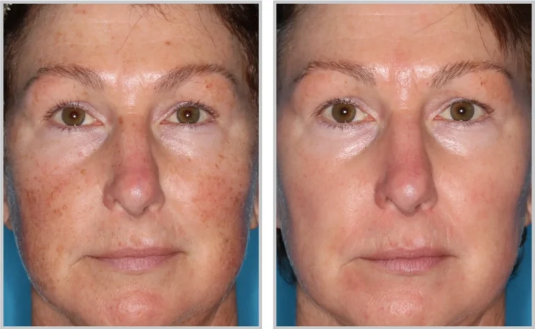 Before and After Halo Laser Treatment - Face